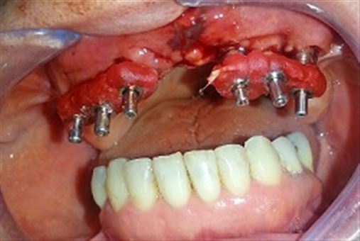 Reabilitação oral implantossuportada – relato de caso