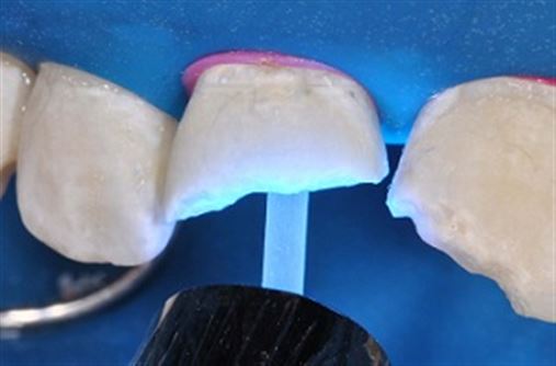 Reconstrução de dente anterior fraturado com restauração direta associada a pino de fibra de vidro – relato de caso