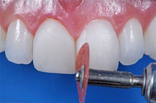 Coluna Sakamoto: Integração entre cirurgia plástica periodontal e Odontologia Restauradora em reabilitação estética com resinas compostas (parte 2) – estratificação em resinas compostas