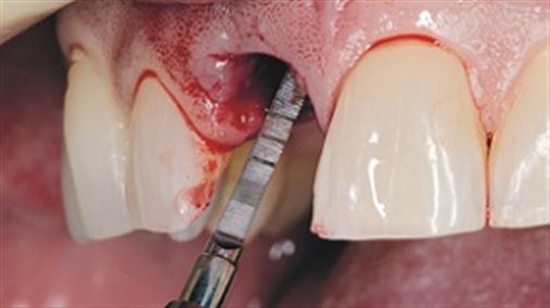 Coluna Informação e Tecnologia: Controle da dinâmica do comportamento anatômico e biológico em reconstruções imediatas com implantes dentais em áreas estéticas: conceito de “overbuilding”