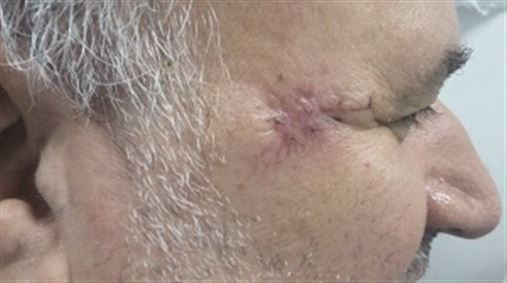 Carcinoma basocelular adenoide – biópsia excisional como tratamento – relato de caso