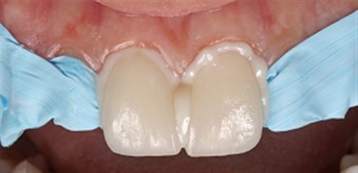 Desenho digital do sorriso no planejamento interdisciplinar entre periodontia e prótese – relato de caso