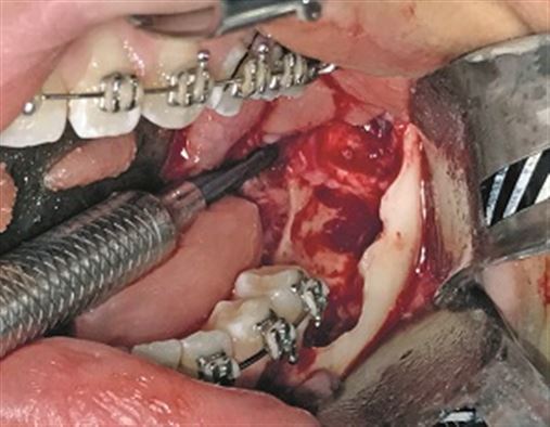 Rara impacção dental de primeiro, segundo e terceiro molares com risco de fratura mandibular – relato de caso