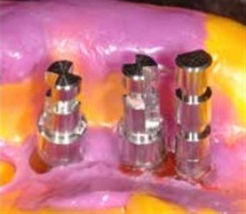 Utilização de implante curto associado a micro pilar protético, uma alternativa para não realização de cirurgia de levantamento de seio maxilar – relato de caso