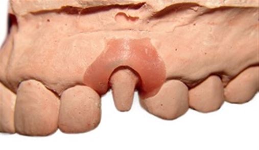 Uso de elastômero para delimitação do término do preparo em modelos odontológicos