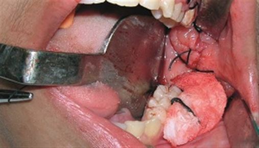 Descompressão de cístico dentígero gigante – relato de caso