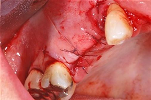 Levantamento de seio maxilar utilizando osso liofilizado associado a PRF – relato de caso