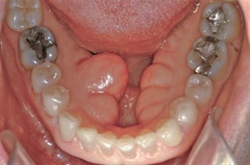 Remoção cirúrgica de grande tórus mandíbular – relato de caso