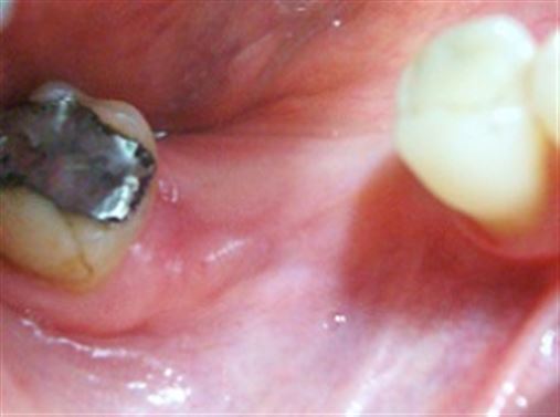 Cirurgia livre de retalho para colocação de implantes