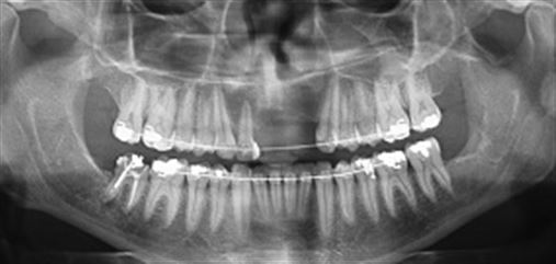 Cisto dentígero associado a dente supranumerário – relato de caso