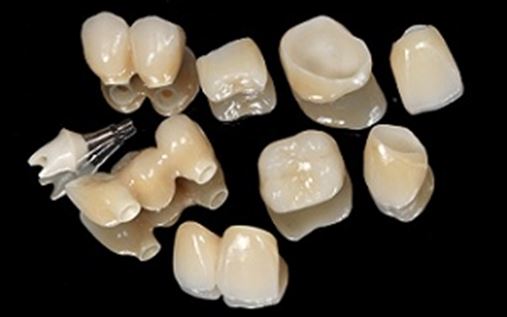 Coluna do Aloísio: Reabilitação oral – parte 2: prótese total implantossuportada na mandíbula associada a próteses cerâmicas na maxila