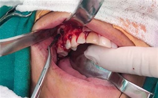 Sinusopatia iatrogênica por corpo estranho (broca de alta rotação) – relato de caso