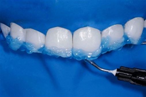 Periodontia – dentística restauradora: uma interação multidisciplinar para a estética do sorriso