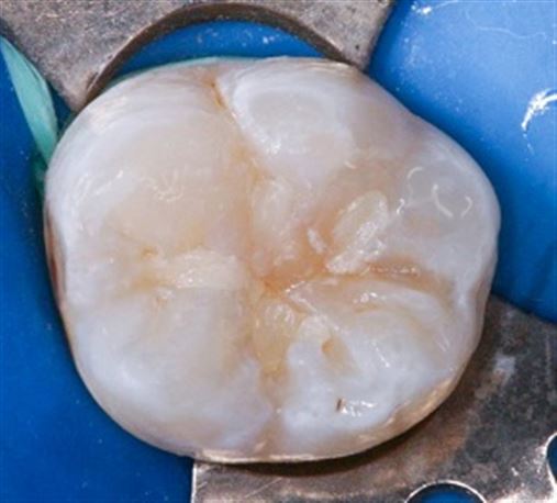 Diagnóstico e tratamento restaurador com resina composta e matriz oclusal em molar com lesão de cárie oculta