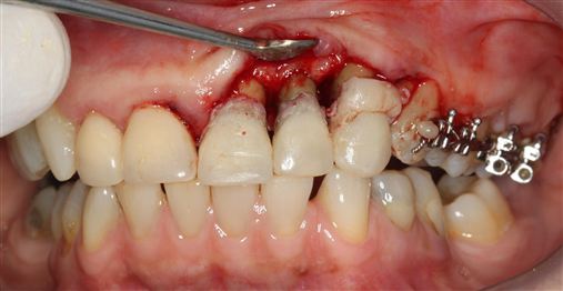 Resolução estética por meio de cirurgia periodontal com reembasamento transcirúrgico e coroas CAD-CAM