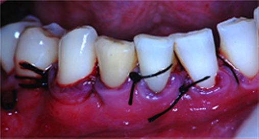 Reparo após cirurgia parendodôntica e preenchimento da cavidade cirúrgica com sulfato de cálcio de dentes indicados à  exodontia – relato de caso
