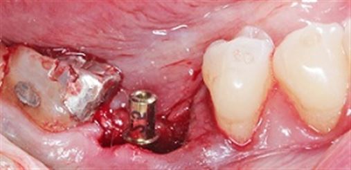 Implantes em molares – quando e porque empregar