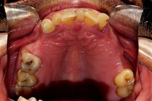 Follow up de 5 anos de implantes dentários imediatos para reabilitação funcional e estética – relato de caso
