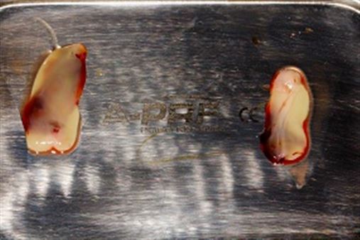 Cirurgia paraendodôntica com uso de A-PRF – relado de caso