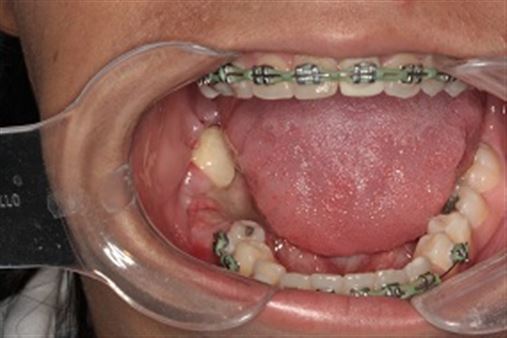 Ressecção segmentar de mandíbula para exérese de ameloblastoma unicístico por acesso intrabucal – relato de caso