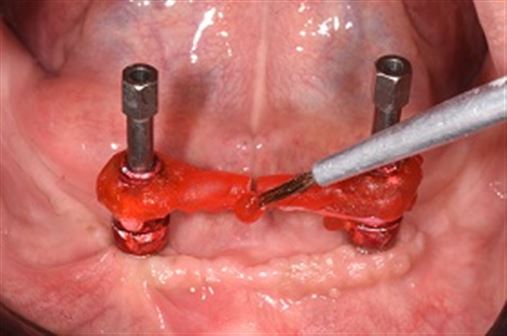 Coluna Prótese Total: O papel do índex de gesso na precisão da transferência de implantes para confecção de sobredentadura mandibular
