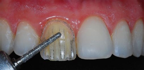 Reabilitação estética de dente anterior escurecido com facetas em resina composta: relato de caso