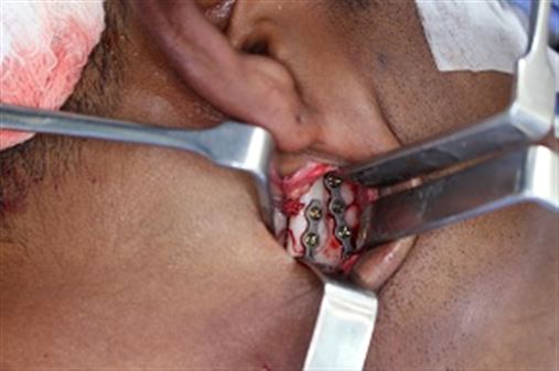 Acesso retromandibular não transparotídeo para tratamento de fratura condilar – relato de caso