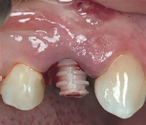 Coluna Grois: Implante de zircônia em dentes posteriores em extração imediata