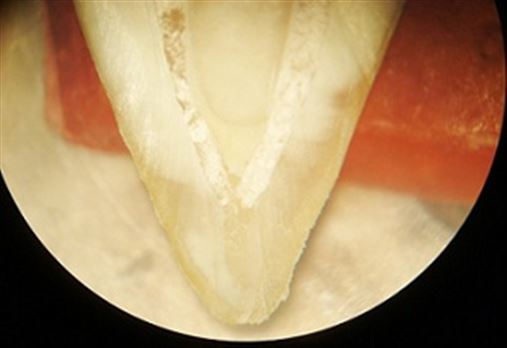 Análise da limpeza no terço apical em molares inferiores humanos por meio de microscopia óptica e de varredura