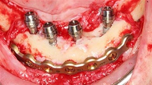Possibilidades terapêuticas atuais para reabilitações implantossuportadas em mandíbulas atróficas