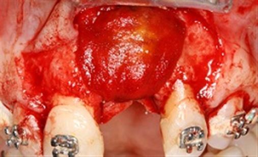 Implante dentário associado à regeneração óssea guiada (ROG) no tratamento do edentulismo unitário em área  estética – relato de caso