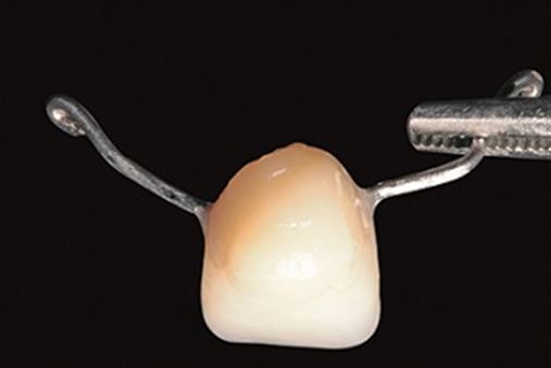Regeneração da parede vestibular em implante anterior com uso de  Bio-Oss® – relato de caso