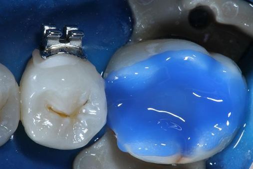 Técnica indireta com resinas compostas para uso direto em restauração de dentes posteriores: cimentação resinosa – Parte III