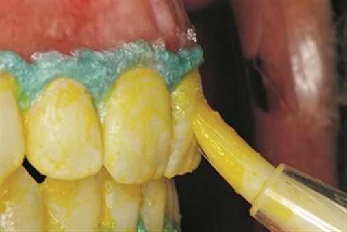 Combinação de técnicas para clareamento dentário em dentes vitalizados