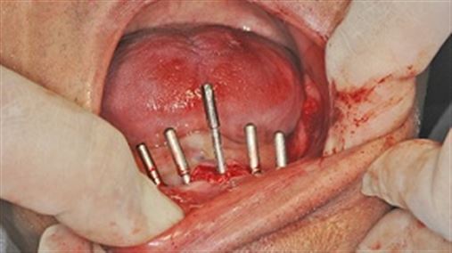 Reabilitação de mandíbula edêntula com implantes sob carga imediata e utilização de barra distal – relato de caso
