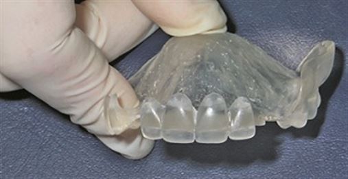 Reabilitação de maxila com prótese total cerâmica dentogengival