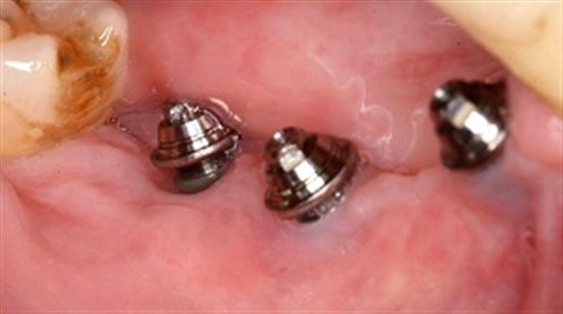 Avaliação da higiene oral em prótese fixa múltipla sobre implantes expostos após necrose óssea – relato de caso