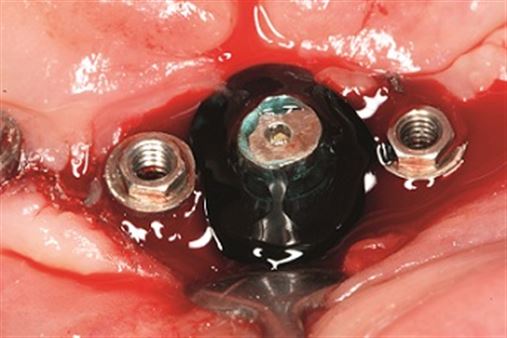 Implantoplastia no tratamento da peri-implantite – relato de caso