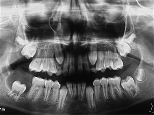 Tratamento conservador de um cisto odontogênico – relato de caso