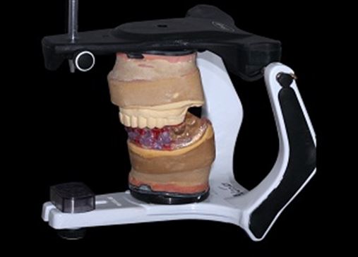Coluna do Aloísio:  Reabilitação oral – parte 1: prótese total implantossuportada na mandíbula associada a próteses cerâmicas na maxila