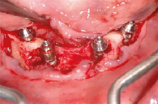 Fratura de mandíbula após a instalação de implantes – relato de caso