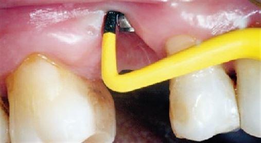 Factors associated with long-term stability of dental implants