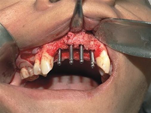 Uso de dentina autógena como material complementar em enxertos ósseos para implantes dentários – relato de caso