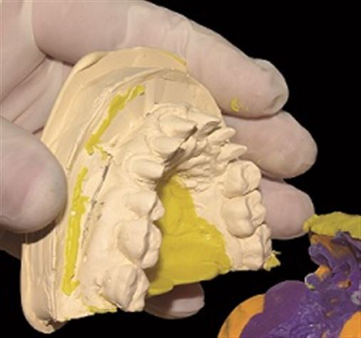 Modelos seccionados para confecção de prótese fixa