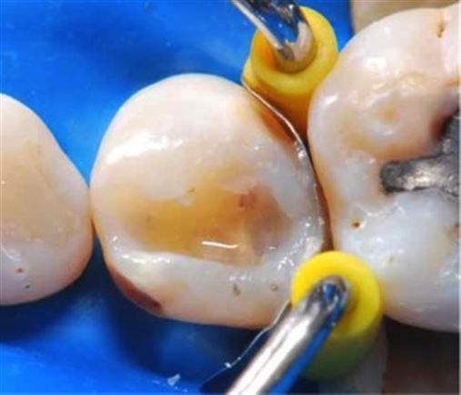 Restaurações em dentes posteriores com incremento único referente à dentina