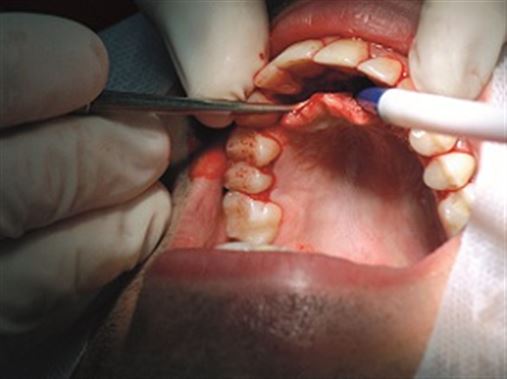Enucleação de lesão isolada em maxila associada à aplicação de produtos Blue M® – relato de caso