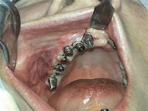Reconstrução de maxila atrófica com enxerto proveniente de calota craniana para posterior reabilitação com implantes dentários – relato de caso