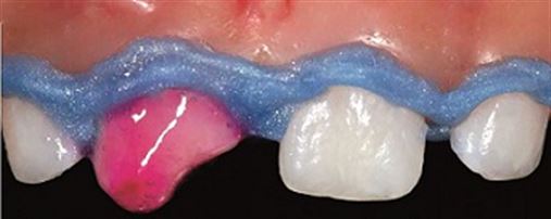 Estética em dentes decíduos traumatizados – clareamento e restauração