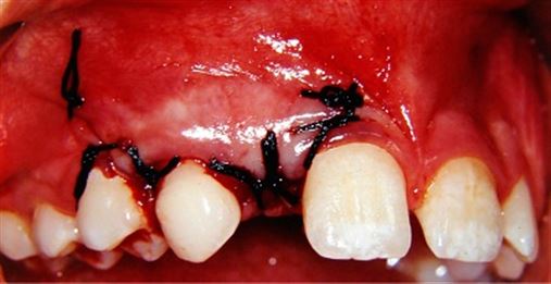 Impactação de dente decíduo – relato de caso