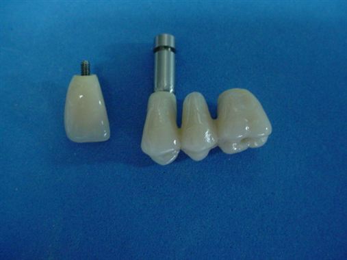 Proposição das próteses temporárias como uma solução imediata para a implantodontia